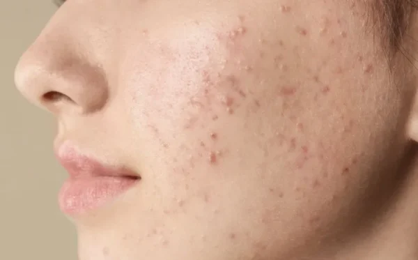 Rebote acné facial post verano